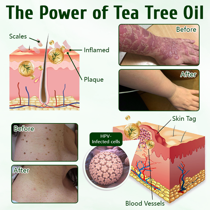 LOVILDS™  Tea Tree Healing Cream